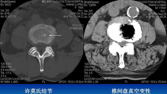 腰椎间盘CT诊断：椎间盘膨出、突出、椎管狭窄及退行性病变