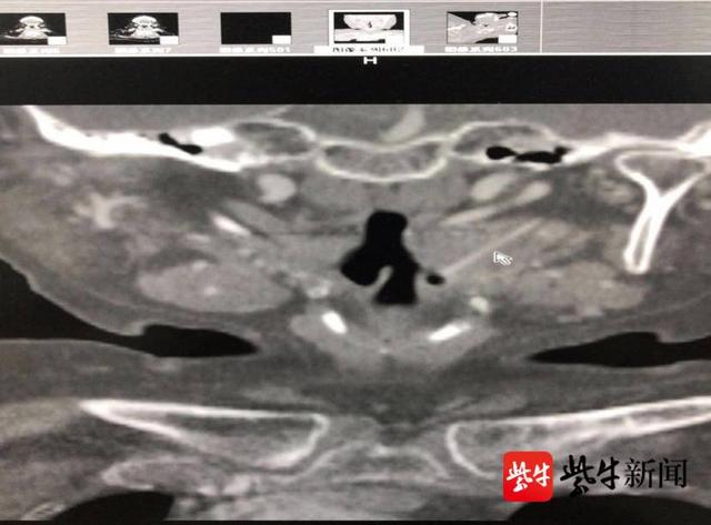 异物|被鸡骨“锁喉”！张家港一老人被切除扁桃体才取出骨头，医生：吞饭喝醋没用