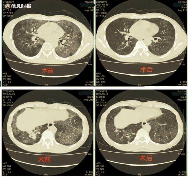 尘肺|惊呆！男子去医院“洗肺”，竟洗出37瓶“乳液”