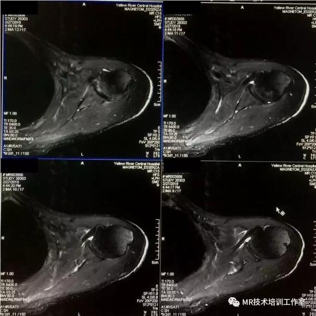 做磁共振检查最易忽视告知受检者去除的两类物品，你可能真没想到