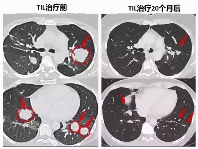 超幸运！一种“不被医学界重视”的抗癌药，却让我的肿瘤消失了