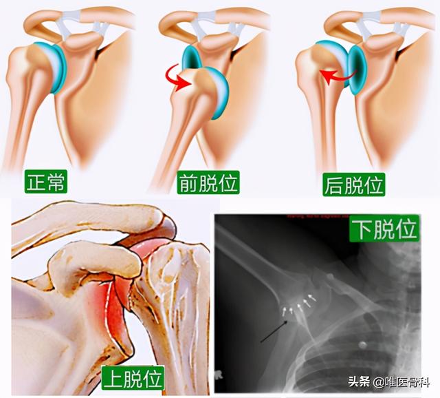 肩膀疼？一个动作，自测是否有肩关节脱位