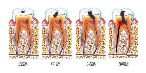 相亲相爱|注意啦！儿童蛀牙率高达71%