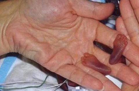 有趣的爱|比手掌还小的婴儿火了，出生时只有245克，现状却让人“失望”