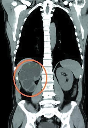 男子头晕 竟查出右肾“丢”了