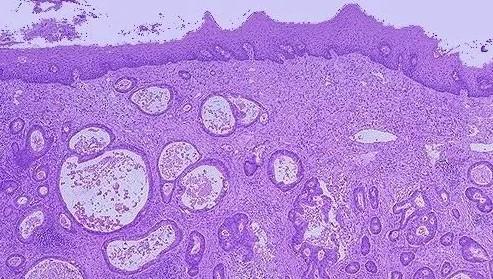 患者|因胃炎入院，却查出癌症！胃出现这4种情况要谨慎