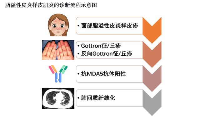 患者|上海专家发现特殊类型皮肌炎——脂溢性皮炎样皮肌炎