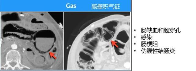 什么是 CT 增强？强化程度、模式、扫描时相等问题逐一解答