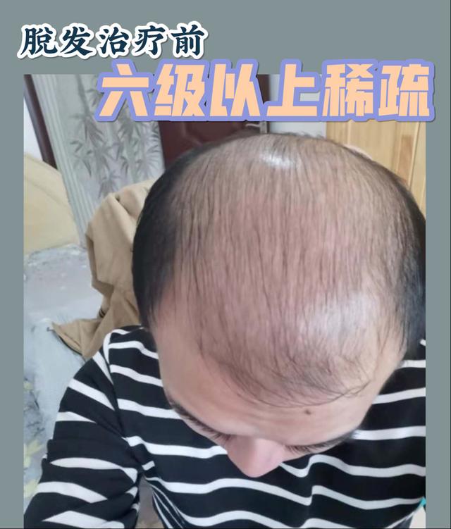 非那雄胺的真实有效率是多少（五位发友改善一年，终于告别稀疏）