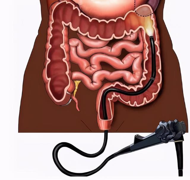 为什么多数人不愿做肠镜？做一次肠镜，可保肠道几年“放心”