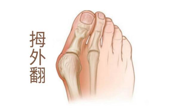 外翻|我的大脚趾怎么越来越歪？