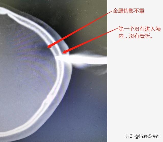 你的育儿经▲熊孩嬉闹 剪刀入脑 上篇飞刀 这个更孬