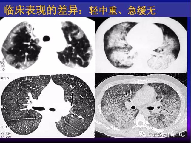 肺间质性疾病的解剖、病理、影像分析