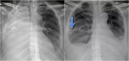 一文总结肺不张的影像学表现丨以影识病