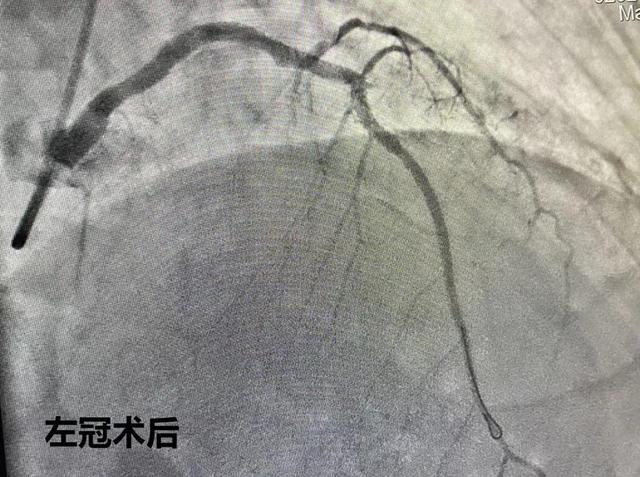 患者|术中多次室速，命悬一线！鲁东医院心内科团队再挽救一条生命