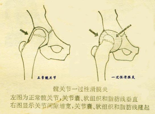 超级宝妈@奇怪的跛行＂鬼怪髋＂——髋关节一过性滑膜炎
