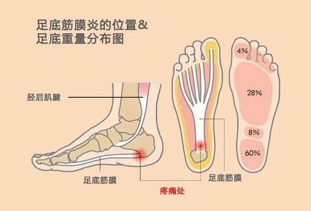 足跟痛有3大“警告”！这样处理才最安全