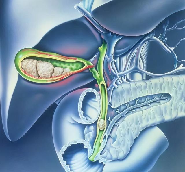 别把胆囊结石不当回事！不痛的胆囊结石，更可怕