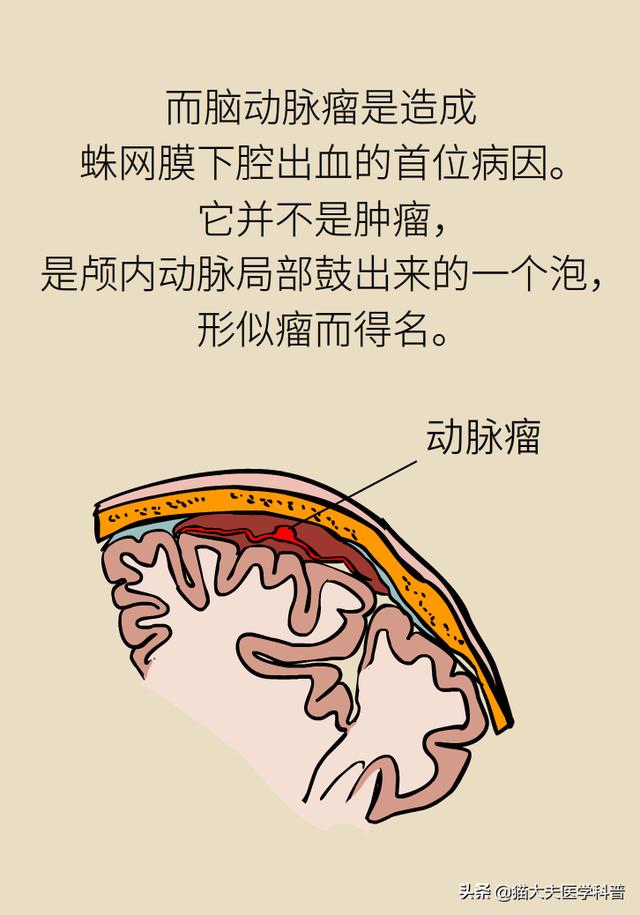 脑动脉瘤之一：脑动脉瘤是脑卒中吗？