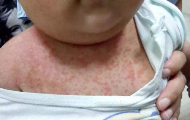 你的育儿经：宝宝第一次发热？家长不用太心急，幼儿急疹了解一下