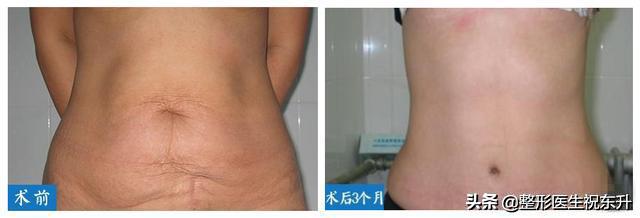 【超级宝妈】产后肚皮松弛、小肚子严重? "平坦小腹赘肉"试试这样做