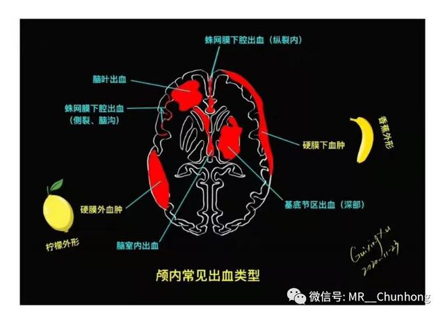 硬膜外与硬膜下出血的血来自哪里