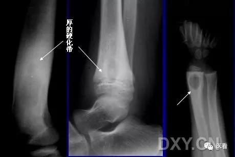 9个骨肿瘤医学影像诊断分析基本要点，如此精彩怎能错过