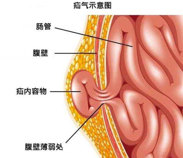 你的育儿经：什么是疝气？常见的小儿疝气有哪些？为什么会形成腹股沟斜疝？