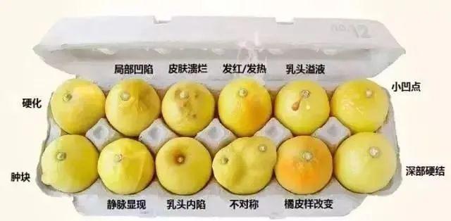 乳腺癌|早期治愈率可达60%以上！乳腺癌筛查和检查这样做