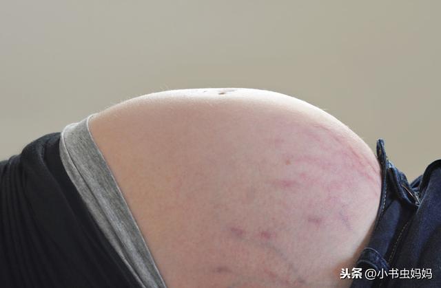 春风▲婆婆会看懂肚子上的妊娠线?妊娠纹的预防和注意方法,孕妇需了解