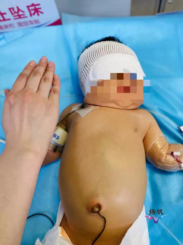 宝宝|惊心动魄！扬州一“熊猫血”新生儿患溶血症，必须全身换血才有生机……