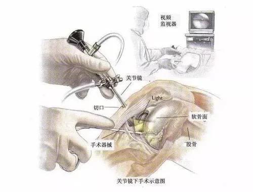 最常见的肩关节痛——肩袖损伤