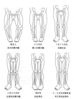 O型腿除了不好看还易患「膝骨关节炎」，难上加难如何才能避免？