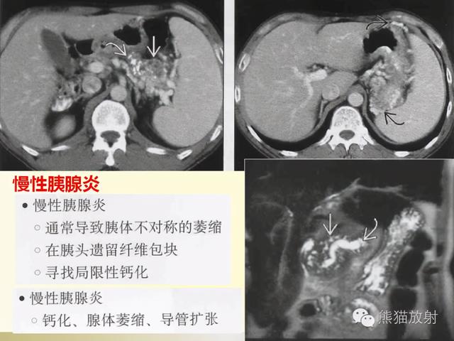 胰腺CT增强扫描、血管评价及病变诊断