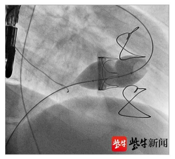 瓣膜|江苏首例!省人医专家应用“干瓣”新技术为患者置换“心门”