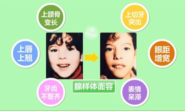 #超级宝妈#长期用嘴呼吸会变丑？宝宝有这些症状，家长要注意了
