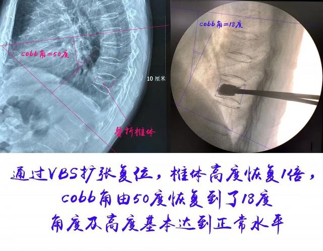 局麻微创钢筋混凝土支架　让骨折驼背脊梁重新挺直