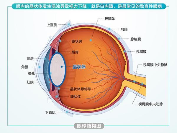 白内障|搞事业！搞出白内障？衡阳“网红”每天凌晨4:30上班，视力仅剩0.02