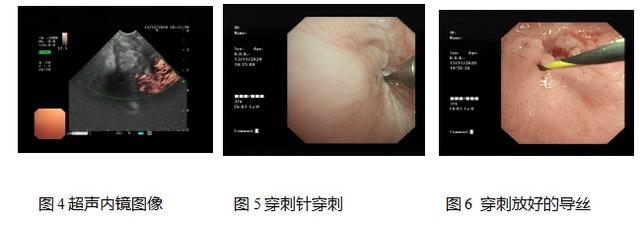 一招鲜！半年不能进食的老大爷终于能饭从口入了