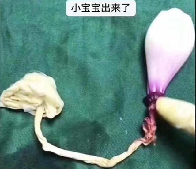你的育儿经|选剖腹产不疼？这根10厘米的麻醉针仅仅是开始，疼到你怀疑人生