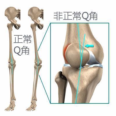 膝关节疼痛、经常打软腿？一种自测方法找原因，四个动作练起来