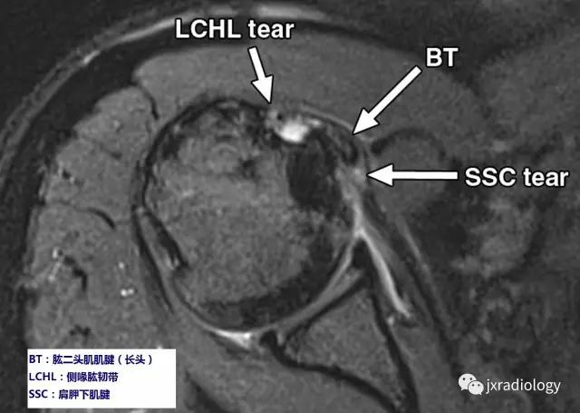 肩袖间隙的解剖及常见病变