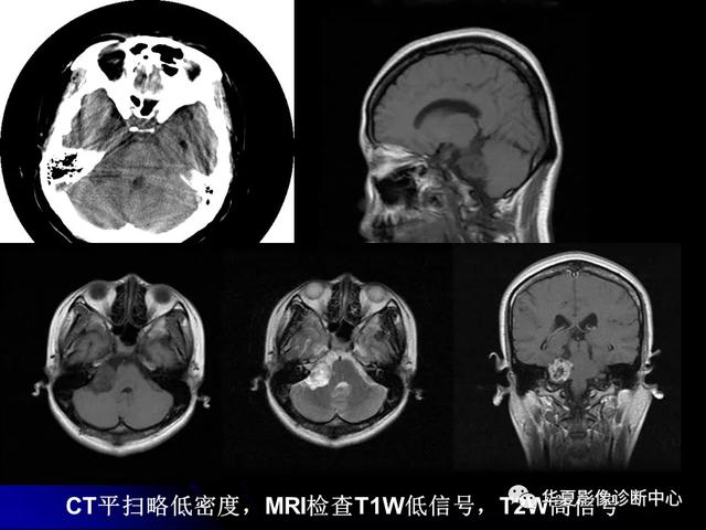 「影像复习」脑干区常见病变影像表现