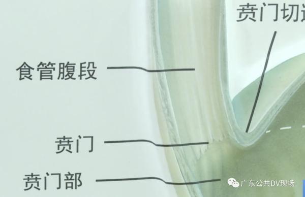 减肥|为了减肥，将催吐管插入胃里50CM……这些减肥方法危害想过吗？