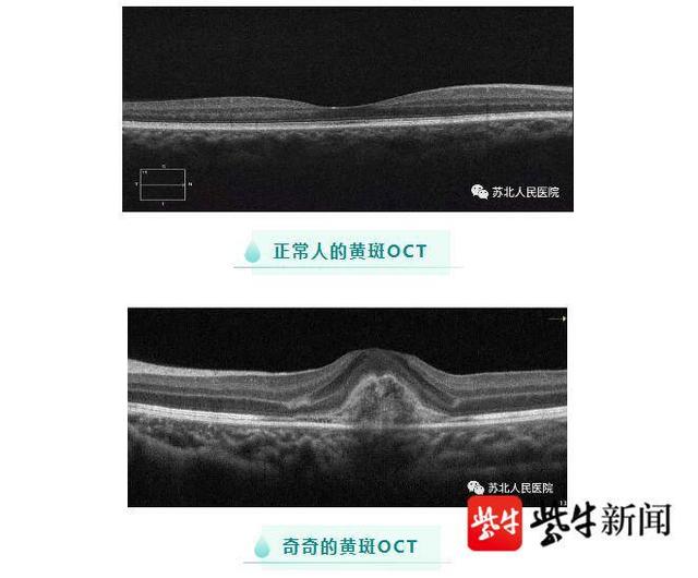 不见|就是这个玩具，险些让6岁男孩失明