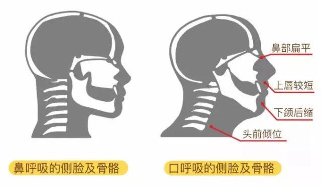 「超级宝妈」砭治腺样体肥大、小儿磨牙