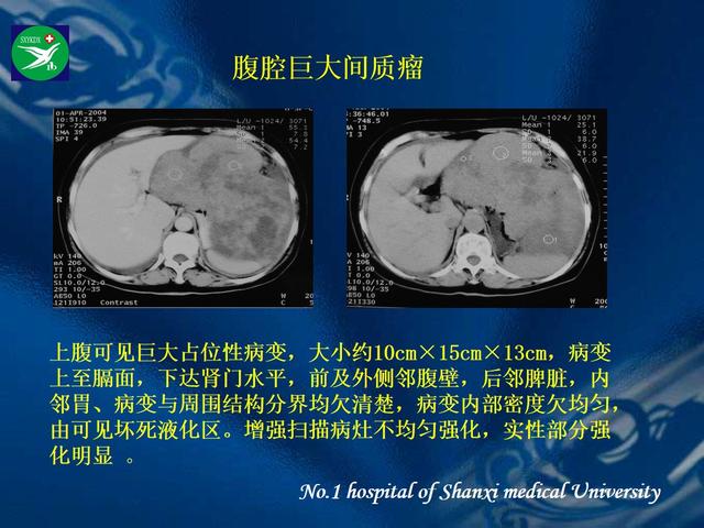 李健丁教授：胃肠道外间质瘤的CT表现和临床病理分析