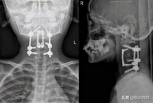 歪脖子背痛警惕脊柱畸形！医生两次手术让她们挺胸抬头，走向新生