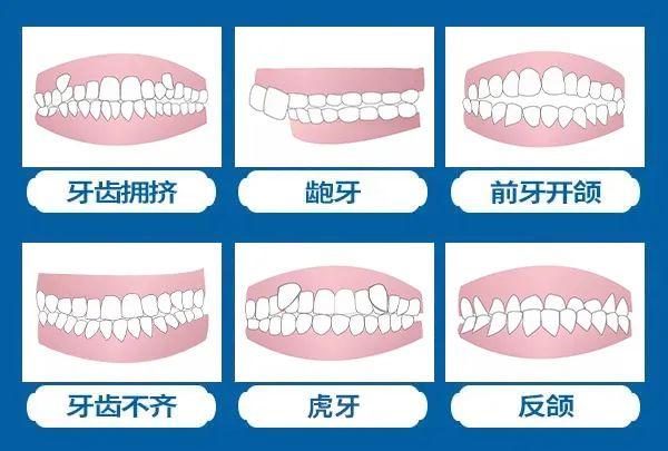 口腔|@全河南人！大河报年末看牙大额减免已全面开启：牙齿矫正每满299元减免150元，种植体低至1520元