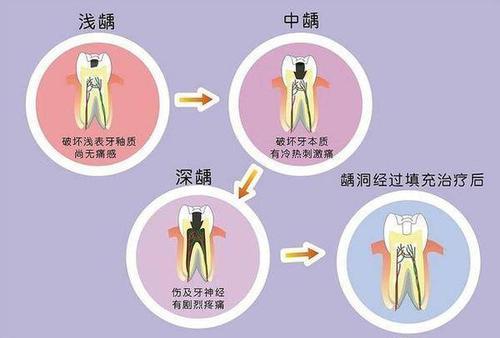 咀嚼功能|牙齿烂了之后，补牙后医生建议要戴牙冠，真的有必要吗？